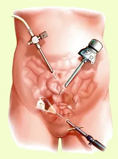 Laparoscopic Ovarian Cyst Removal