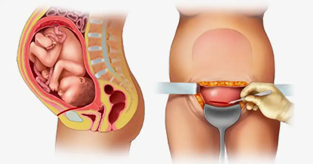 Painless Cesarean Section