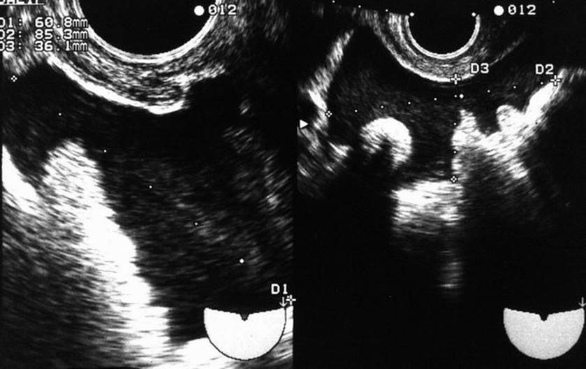 Pregnancy of Unknown Location Follow Up