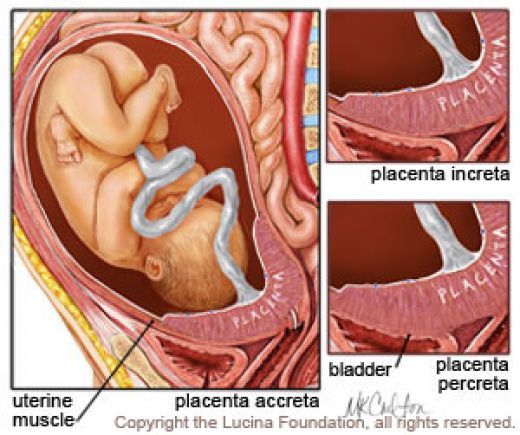 Treatment of Placenta Previa and Placenta Accreta