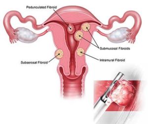 Uterine Fibroid Removal