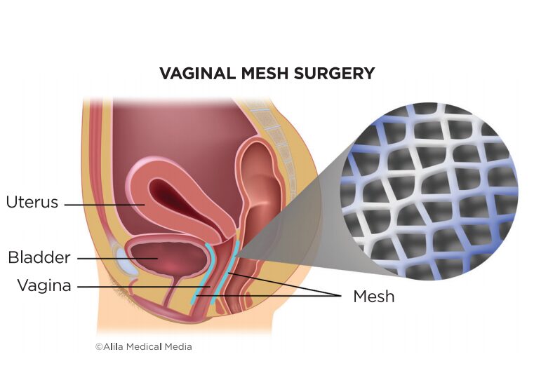Vaginal Prolapse Surgery